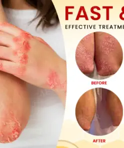 RZXEA™ Bee Venom Psoriasis Treatment Cream