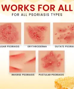RZXEA™ Bee Venom Psoriasis Treatment Cream
