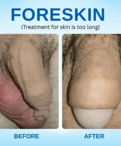 RZXEA™ Redundant Prepuce Corrector Gel