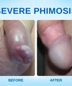 RZXEA™ Redundant Prepuce Corrector Gel