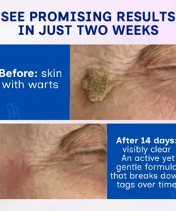 RZXEA™ Solid-Stick Wart Remover, Skin Tags in Just 48 Hours