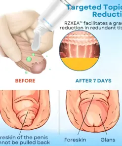 RZXEA™ 7-Day Redundant Prepuce Corrective Gel