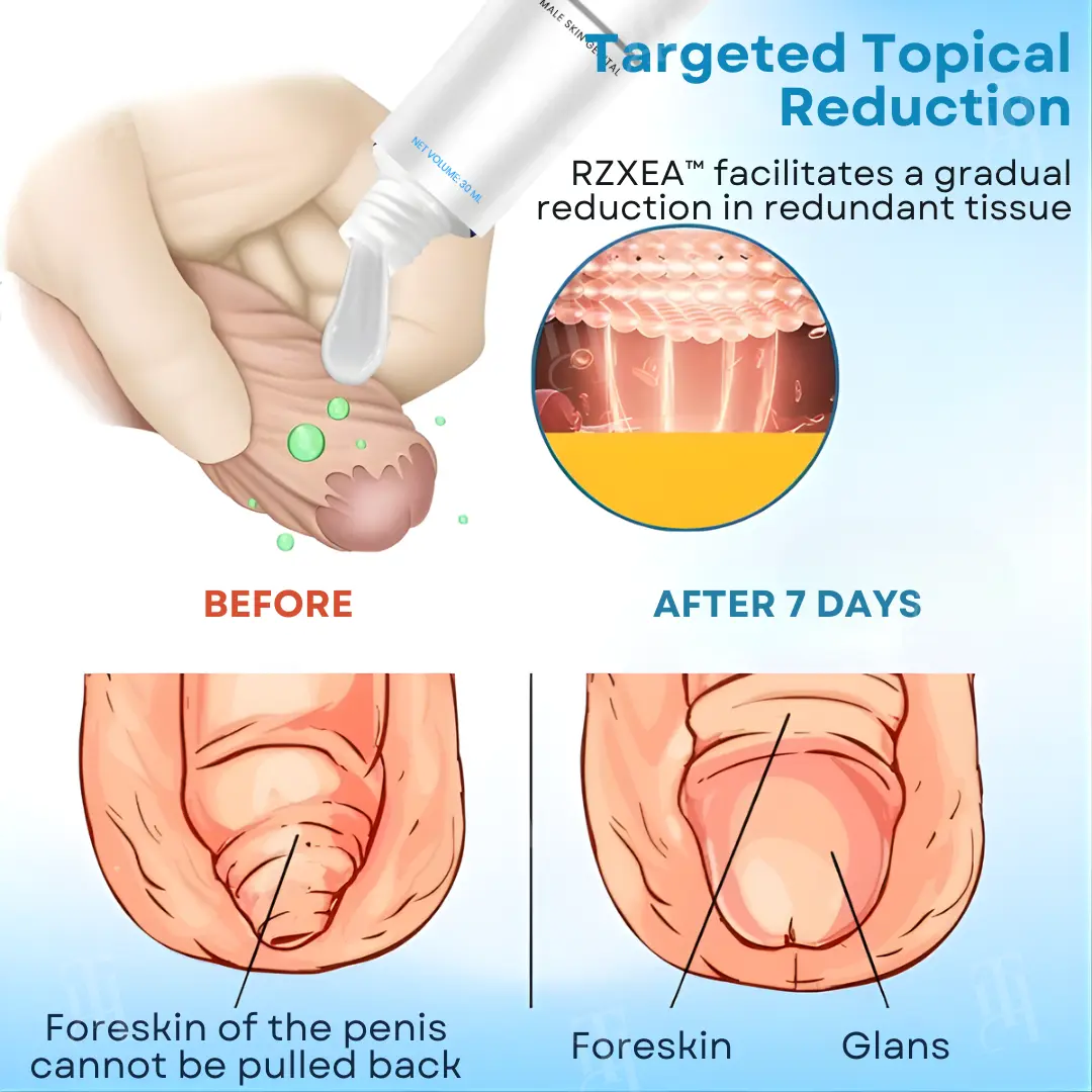 RZXEA™ 7-Day Redundant Prepuce Corrective Gel