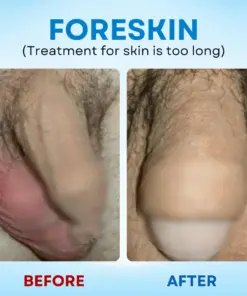 RZXEA™ 7-Day Redundant Prepuce Corrective Gel