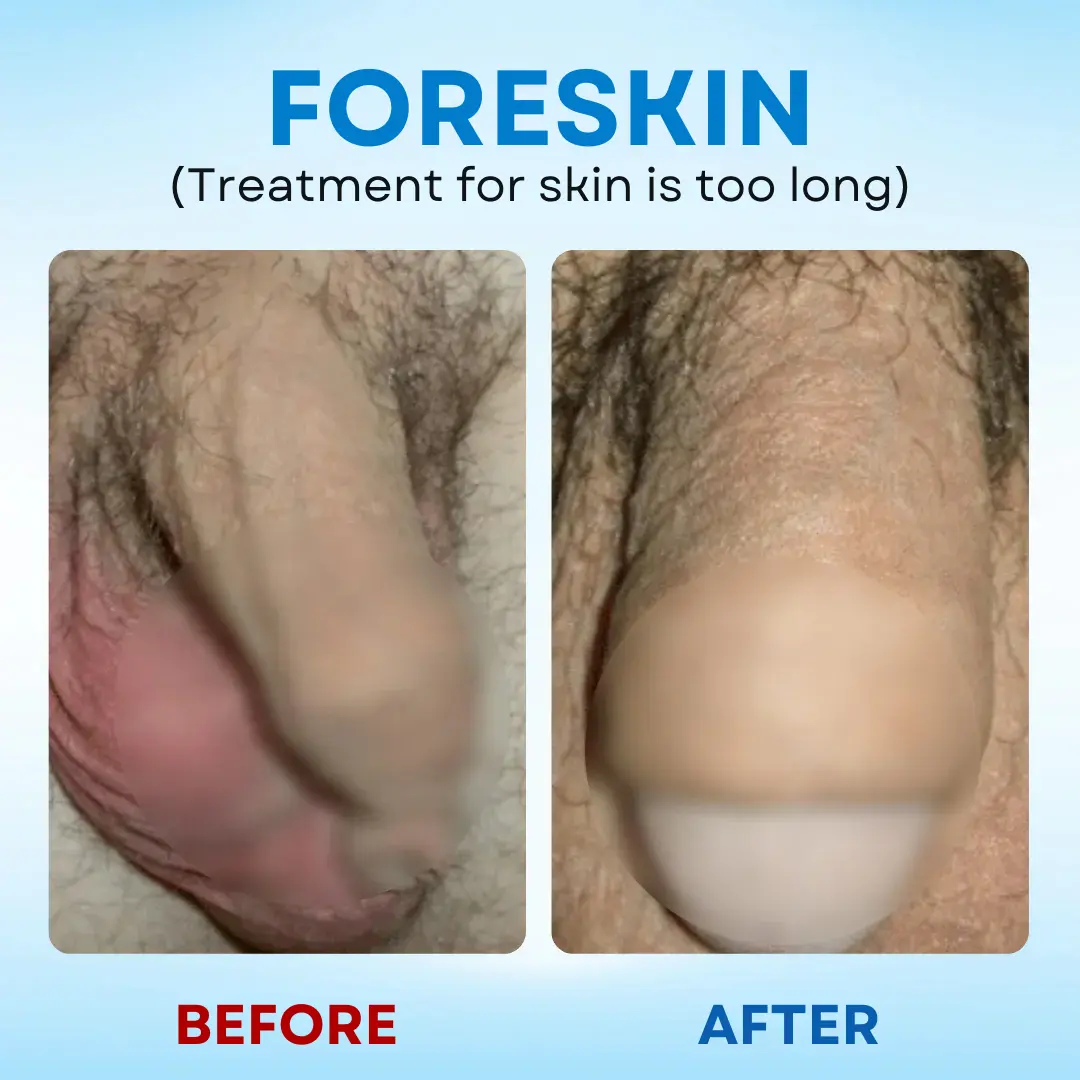 RZXEA™ 7-Day Redundant Prepuce Corrective Gel