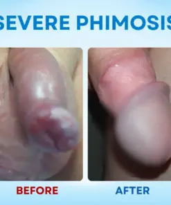 RZXEA™ 7-Day Redundant Prepuce Corrective Gel