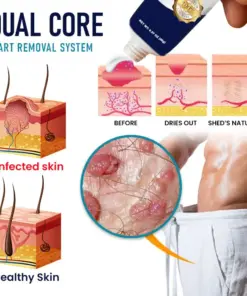 RZXEA™ Genital Warts Remover Cream