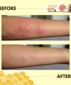 RZXEA™ Bee Venom Bio-Peptide 2-Min Instant Itch Relief Cream